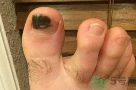 腳趾甲變黑是什么原因？腳趾甲變黑是怎么回事？