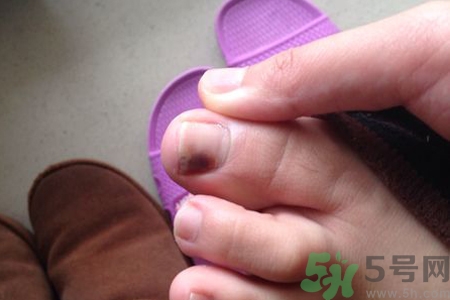 腳趾甲變黑是什么原因？腳趾甲變黑是怎么回事？