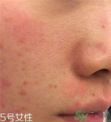 微針可以自己在家做嗎?家用微針幫你祛痘 微針可以自己在家做嗎?家用微針幫你祛痘