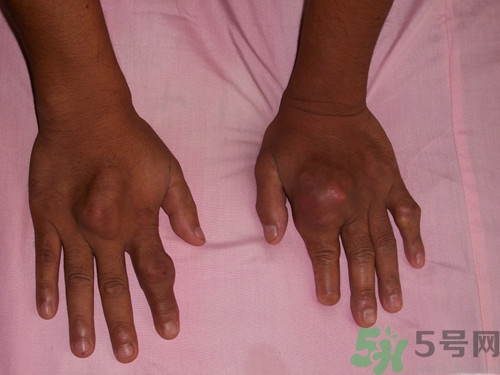 痛風(fēng)可以吃牛板筋嗎?痛風(fēng)吃牛板筋好嗎 痛風(fēng)可以吃牛板筋嗎?痛風(fēng)吃牛板筋好嗎