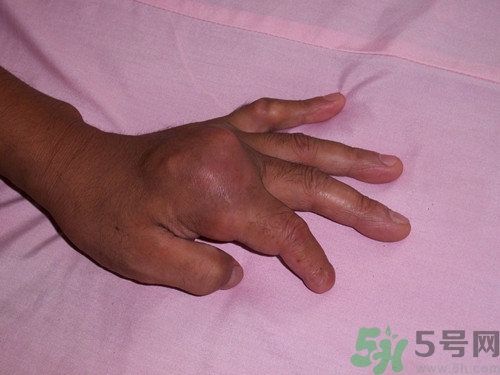 痛風(fēng)可以吃牛板筋嗎?痛風(fēng)吃牛板筋好嗎 痛風(fēng)可以吃牛板筋嗎?痛風(fēng)吃牛板筋好嗎