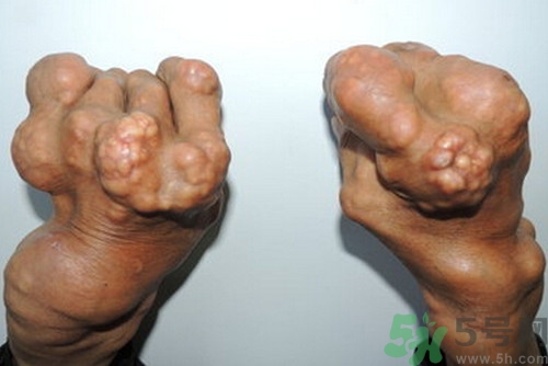 痛風(fēng)可以吃牛板筋嗎?痛風(fēng)吃牛板筋好嗎 痛風(fēng)可以吃牛板筋嗎?痛風(fēng)吃牛板筋好嗎