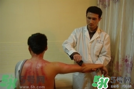 刮痧能治療風(fēng)寒感冒嗎？刮痧治療風(fēng)寒感冒效果好嗎