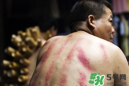 背部刮痧后能拔火罐嗎？背部刮痧后拔火罐有什么好處？