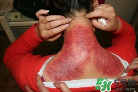 經(jīng)常刮痧對身體好嗎？經(jīng)常刮痧拔罐對身體有什么壞處嗎？