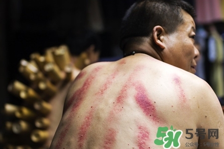 刮痧會(huì)得艾滋嗎？刮痧會(huì)傳染艾滋嗎？