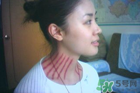 揪痧是什么？揪痧的好處有哪些？