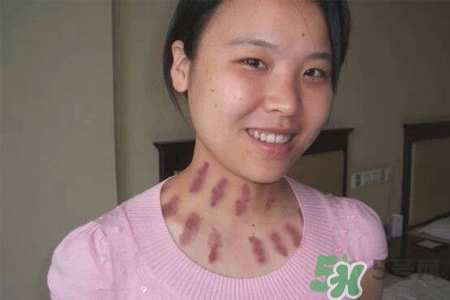 揪痧和刮痧哪個(gè)效果比較好？揪痧和刮痧的區(qū)別？