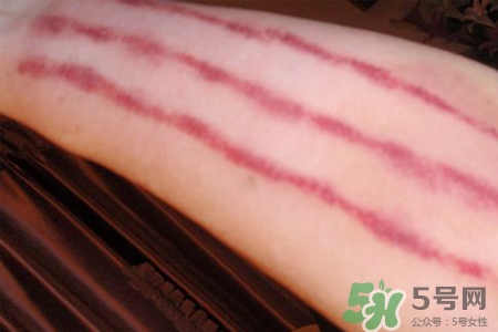 揪痧和刮痧哪個(gè)效果比較好？揪痧和刮痧的區(qū)別？