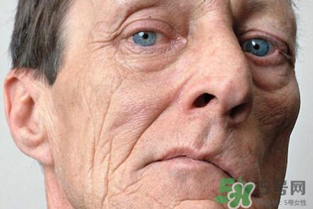 面癱能針灸嗎？針灸能治療面癱嗎？