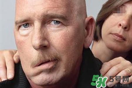 拔牙會導(dǎo)致面癱嗎?？拔牙為什么會導(dǎo)致面癱？