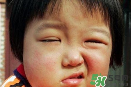 拔牙會(huì)導(dǎo)致面癱嗎?？拔牙為什么會(huì)導(dǎo)致面癱？