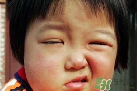 如何預(yù)防面癱復(fù)發(fā)？導(dǎo)致面癱的四大原因