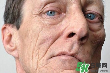 老年人為什么容易得面癱？老年人面癱原因有哪些？