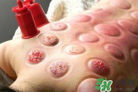 拔罐放血對身體好嗎？拔罐放血有什么好處？