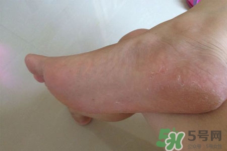 腳趾經(jīng)常抽筋是缺鈣嗎？腳趾抽筋是什么原因？