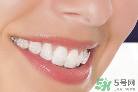 隱形牙套矯正多少錢？隱形牙套多少錢一副？