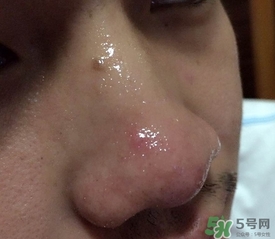 wis去黑頭套裝多少錢?wis去黑頭套裝價格 wis去黑頭套裝多少錢?wis去黑頭套裝價格