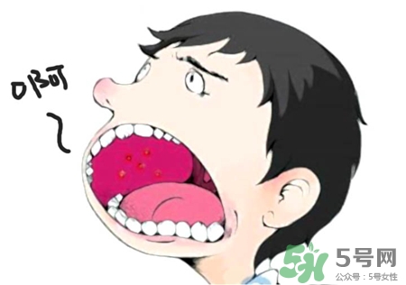 口腔潰瘍會傳染嗎?口腔潰瘍傳染人嗎? 口腔潰瘍會傳染嗎?口腔潰瘍傳染人嗎?