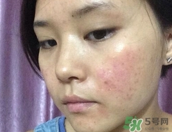 閉合性粉刺用什么藥膏?閉合性粉刺怎么治療? 閉合性粉刺用什么藥膏?閉合性粉刺怎么治療?