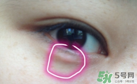 眼睛下面長(zhǎng)痘痘是什么原因?眼睛下面長(zhǎng)痘痘怎么辦? 眼睛下面長(zhǎng)痘痘是什么原因?眼睛下面長(zhǎng)痘痘怎么辦?