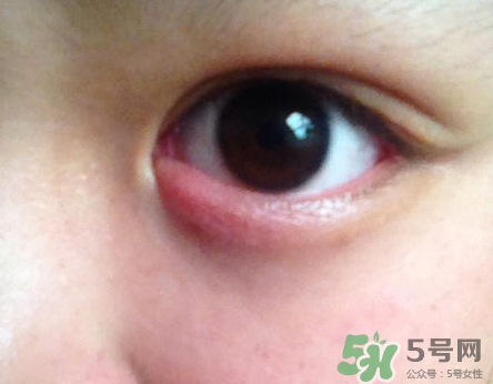 眼睛下面長(zhǎng)痘痘是什么原因?眼睛下面長(zhǎng)痘痘怎么辦? 眼睛下面長(zhǎng)痘痘是什么原因?眼睛下面長(zhǎng)痘痘怎么辦?