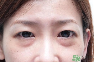 眼睛下面腫得像眼袋是怎么回事?怎么辦? 眼睛下面腫得像眼袋是怎么回事?怎么辦?