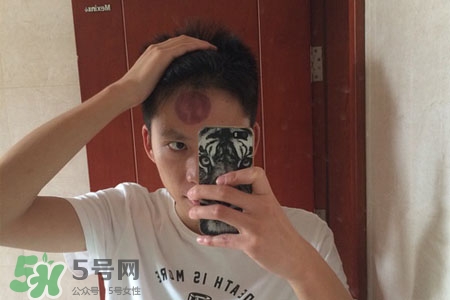 拔罐后皮膚癢能撓嗎？拔罐后身上癢切忌抓撓