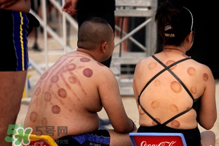 針灸火罐后多久能洗澡？針灸火罐后能馬上洗澡嗎？