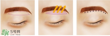 切眉后眼睛腫怎么辦？切眉后眼睛變形怎么回事怎么辦？
