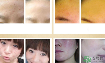 伊詩蘭頓祛痘怎么樣？伊詩蘭頓祛痘膏有用嗎？