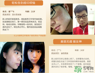 芷軒堂祛痘有效果嗎？芷軒堂祛痘印效果怎么樣？
