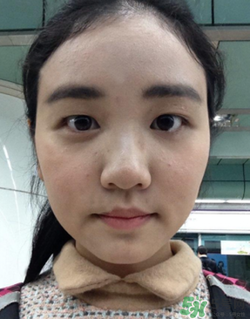 埋線雙眼皮的危害_埋線雙眼皮有風(fēng)險后遺癥嗎 埋線雙眼皮的危害_埋線雙眼皮有風(fēng)險后遺癥嗎