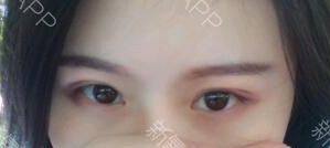 定點(diǎn)雙眼皮能保持多久？定點(diǎn)雙眼皮是永久的嗎？