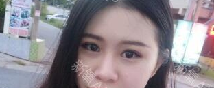 定點(diǎn)雙眼皮能保持多久？定點(diǎn)雙眼皮是永久的嗎？