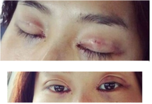 定點雙眼皮怎么做？定點雙眼皮需要拆線嗎？