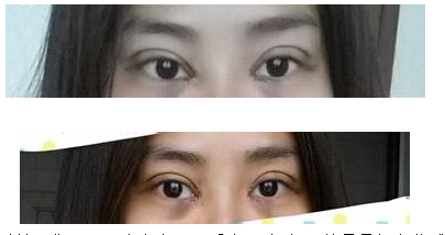 定點雙眼皮怎么做？定點雙眼皮需要拆線嗎？