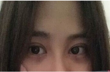 定點雙眼皮怎么做？定點雙眼皮需要拆線嗎？