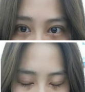 定點雙眼皮怎么做？定點雙眼皮需要拆線嗎？