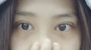 定點雙眼皮怎么做？定點雙眼皮需要拆線嗎？