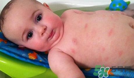 新生兒身上有紅點是怎么回事?是什么原因? 新生兒身上有紅點是怎么回事?是什么原因?