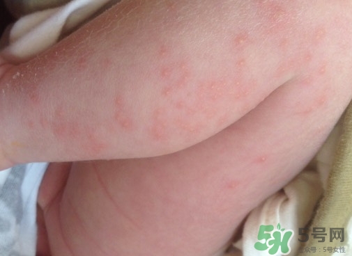 新生兒身上有紅點是怎么回事?是什么原因? 新生兒身上有紅點是怎么回事?是什么原因?