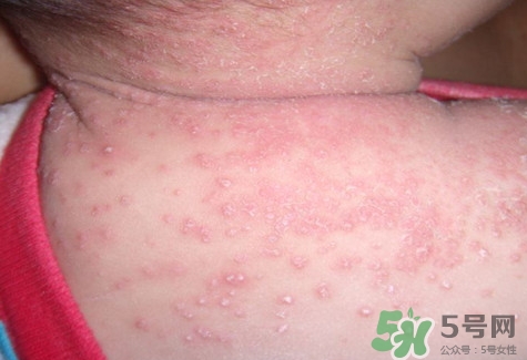 新生兒身上有紅點是怎么回事?是什么原因? 新生兒身上有紅點是怎么回事?是什么原因?