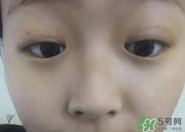 埋線雙眼皮需要拆線嗎？埋線雙眼皮怎么拆線