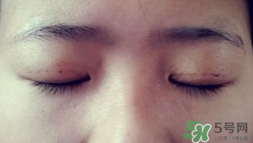 埋線雙眼皮需要拆線嗎？埋線雙眼皮怎么拆線