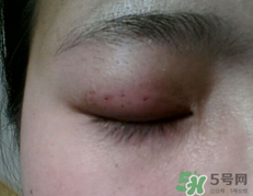 埋線雙眼皮需要拆線嗎？埋線雙眼皮怎么拆線