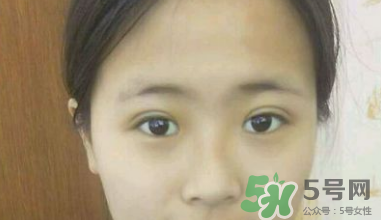 埋線雙眼皮需要拆線嗎？埋線雙眼皮怎么拆線