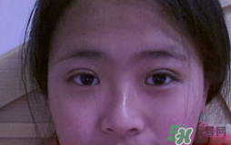 埋線雙眼皮需要拆線嗎？埋線雙眼皮怎么拆線