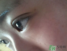 埋線雙眼皮需要拆線嗎？埋線雙眼皮怎么拆線