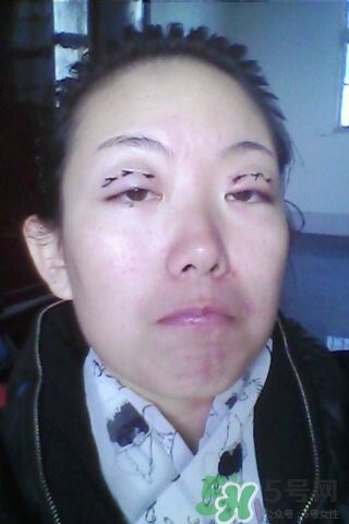 什么是定點(diǎn)雙眼皮？定點(diǎn)雙眼皮多少錢(qián)？